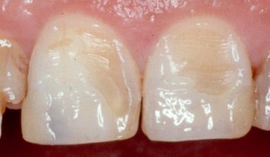 повреждение эмали зуба